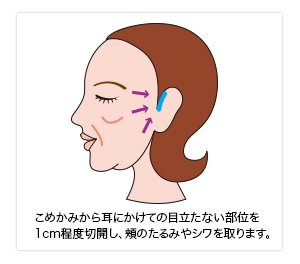 小切開法によるフェイスリフト