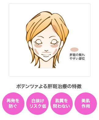 ポテンツァによる肝斑治療の特徴