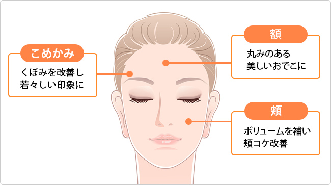「額・こめかみ・頬」ヒアルロン酸集中ケア