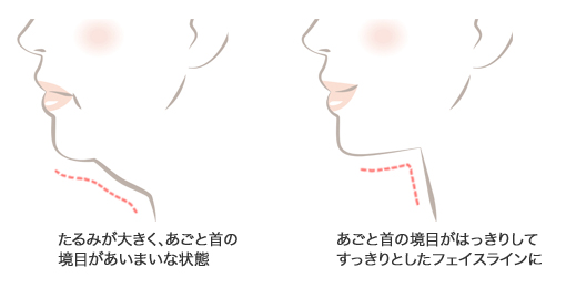 ペリカン手術で、あごと首の境目がはっきりしてすっきりとしたフェイスラインに