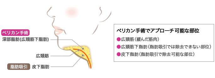 ペリカン手術でアプローチ可能な部位