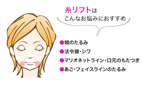 糸リフトはこんなお悩みにおすすめ