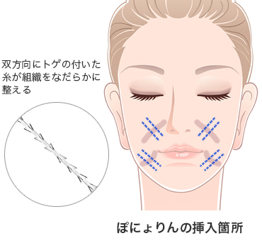ぽにょりん挿入箇所